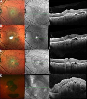 Effects of the COVID-19 Pandemic on Anti-vascular Endothelial Growth Factor Treatment in China